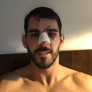 Nélson durante a recuperação depois de ter sido pisado na cara por Tyrone Mings