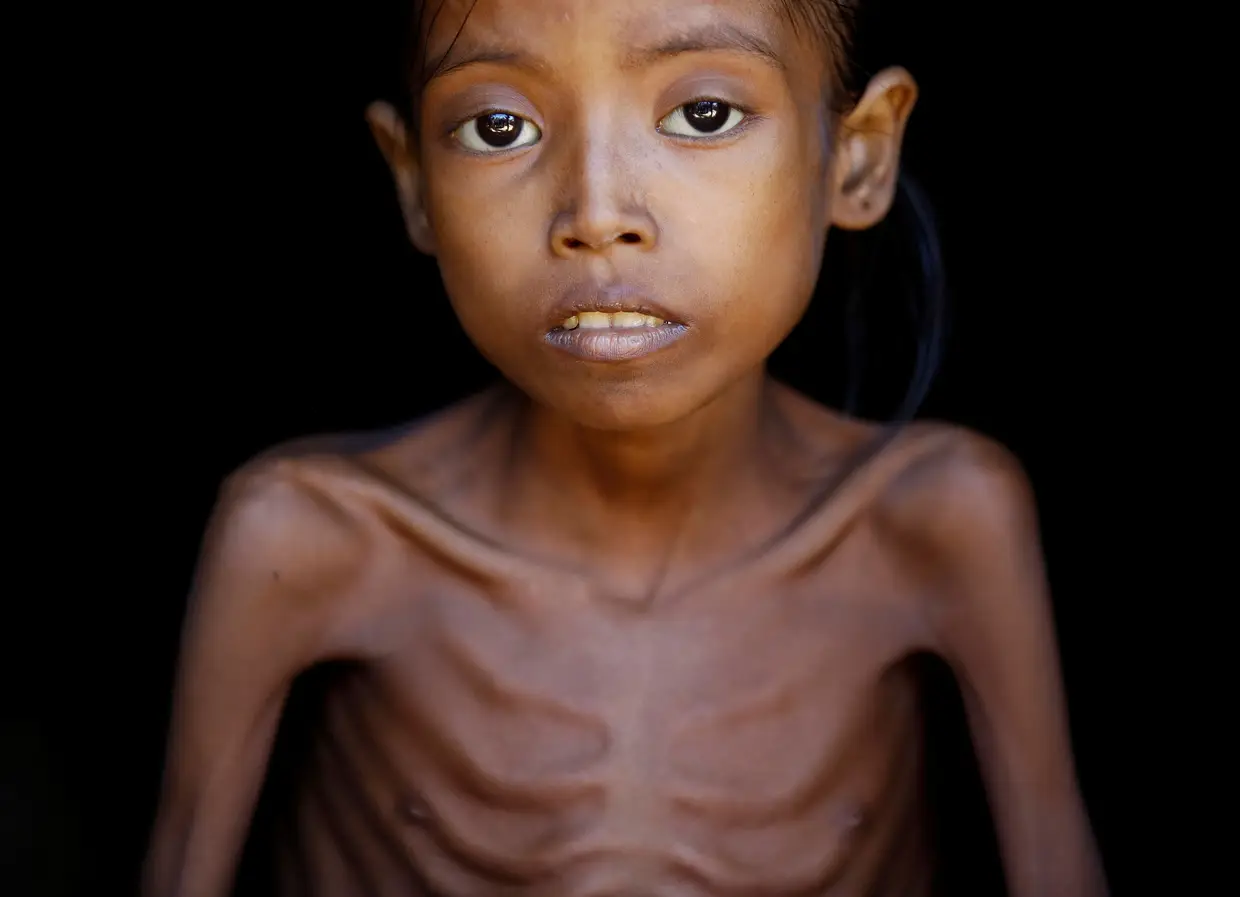 Novembro - Ismot Ara, de 7 anos, é uma menina rohingya vítima de desnutrição que vive num campo de refugiados no Bangladesh.