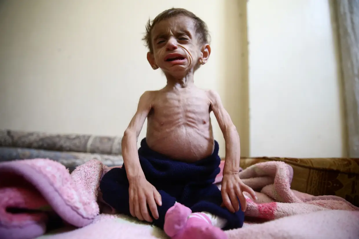 Outubro - Hala al-Nufi, 2 anos e meio e menos de 5 quilos. É uma das crianças vítimas da fome em Damasco, Síria. Sofre de um distúrbio metabólico, mas a falta de comida tornou a sua situação ainda mais grave.