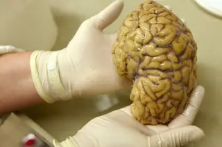 Morte de células cerebrais na doença de Alzheimer é benéfica