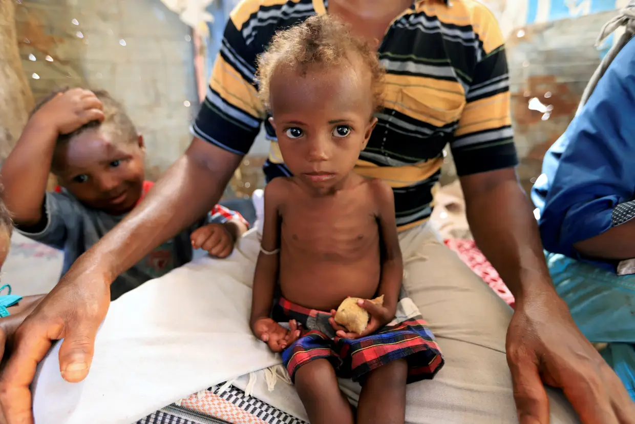 Menina malnutrida sentada ao colo do pai em Hodeidah, Iémen.