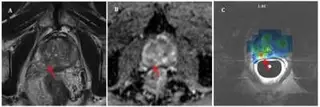 Cancro da próstata detetado através de ressonância magnética hiper-polarizada.