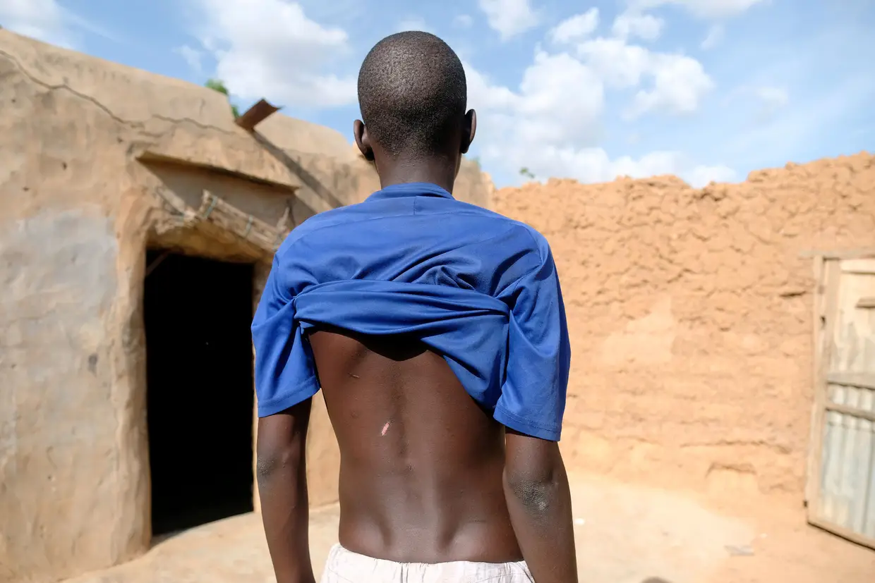 Rapaz mostra cicatrizes nas costas na cidade de Daura, na Nigéria. Segundo conta, foi espancado durante 13 dias num centro de reabilitação islâmico