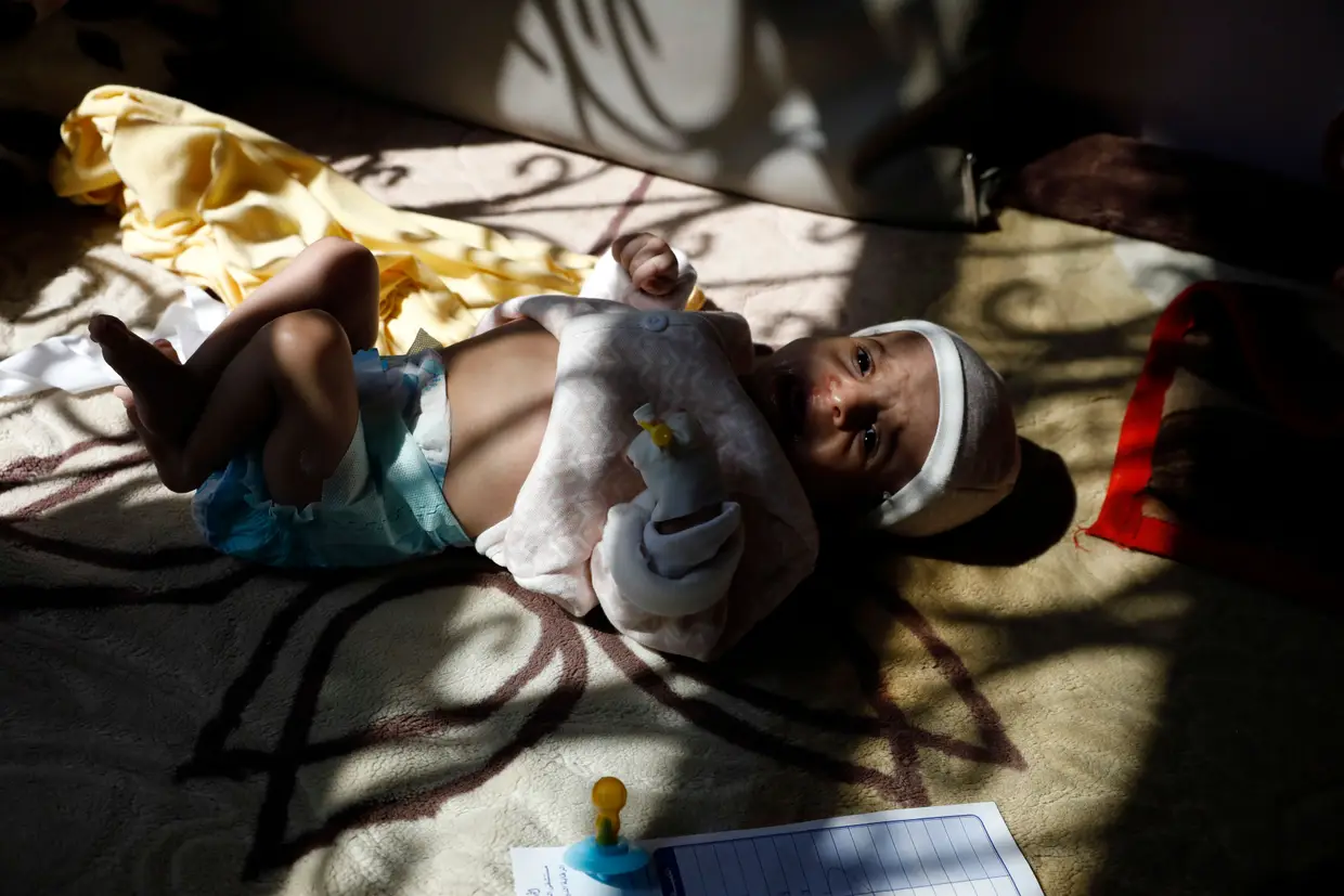 Uma criança desnutrida deitada numa cama enquanto recebe cuidados médicos num hospital em Saná, no Iémen. A ONU e grupos de ajuda humanitária alertaram que a designação dos Houthis pelos EUA como organização terrorista estrangeira pode ter sérios impactos sobre a já terrível situação humanitária no Iémen, particularmente sobre o risco de fome.