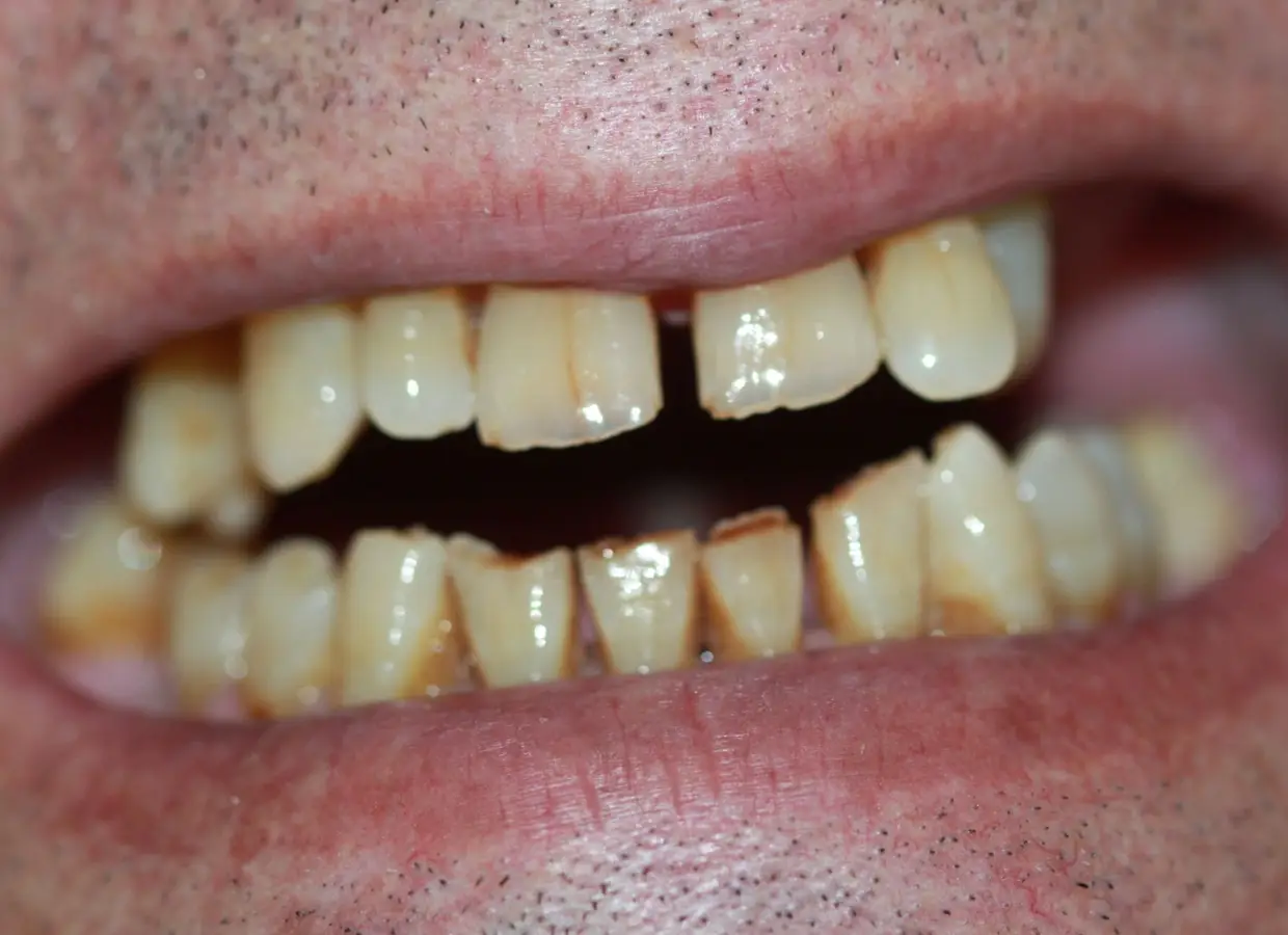Os dentes de Carlos Areia antes deste processo.