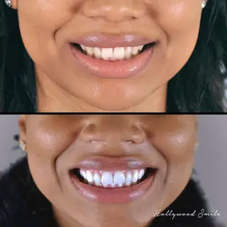 Hoje - Hollywood Smile, clinica Mint