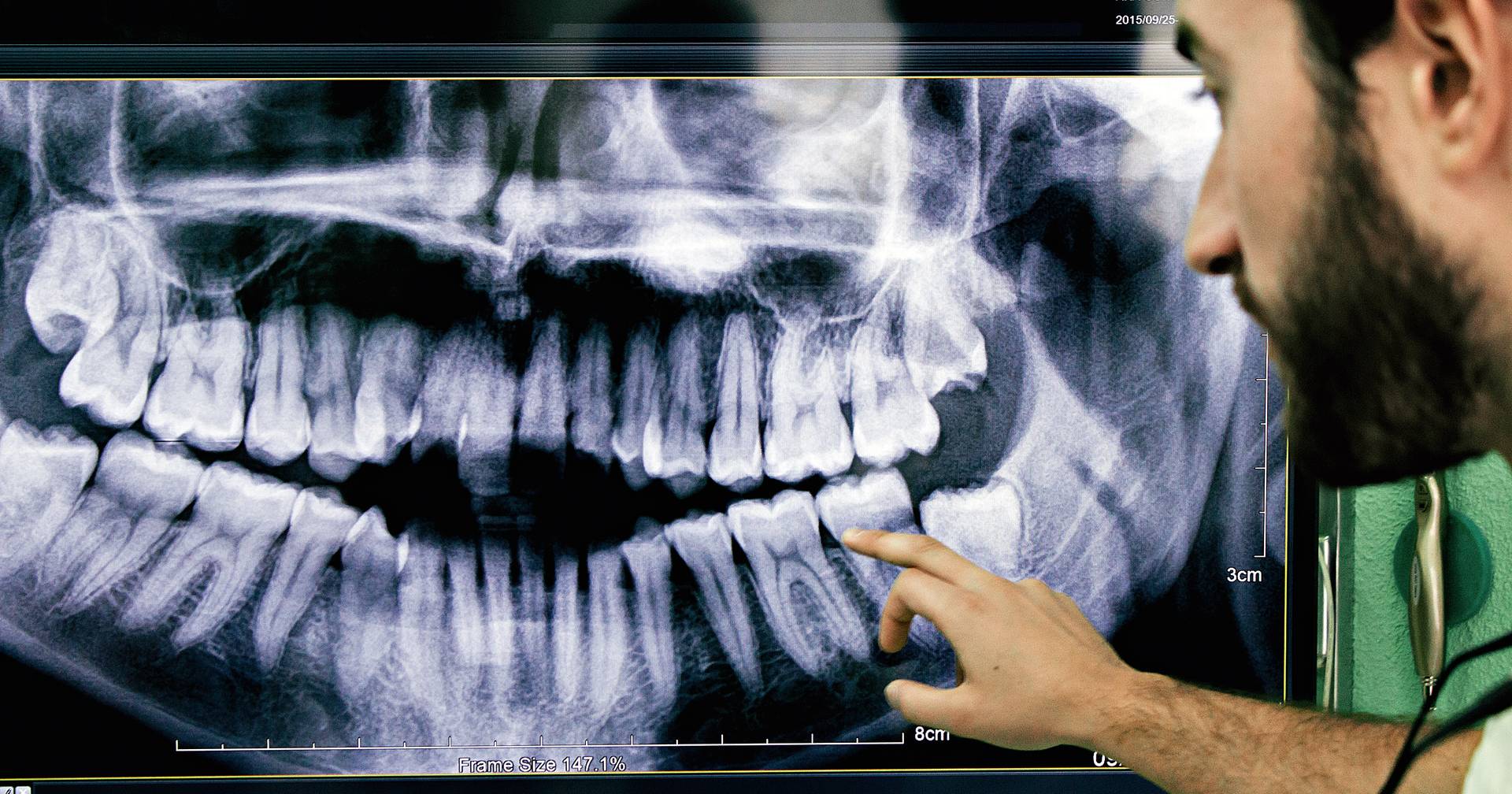 Рентген открытого рта зубов
