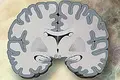 Alzheimer entre a euforia e a desilusão