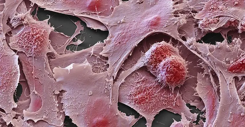 Na Europa, estima-se que em cada 100 mil mulheres, cerca de 10 sejam afetadas por cancro do ovário, sendo que é a 5.ª causa de morte por doença oncológica nas mulheres, a seguir ao cancro da mama, do pulmão, do intestino e do pâncreas