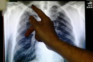 “As pessoas fugiam de nós”: covid-19 provocou um estigma nos doentes semelhante ao da tuberculose, mas depois também o ajudou a combater