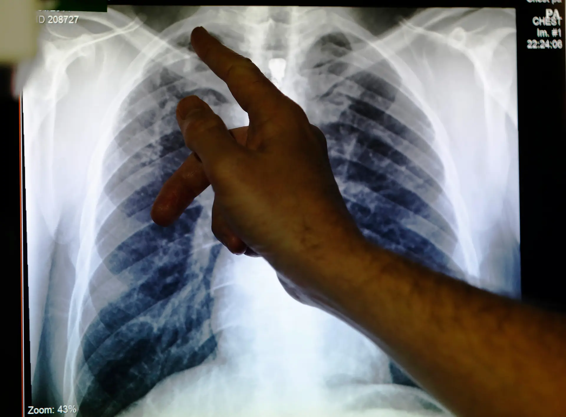 Pela primeira vez em 20 anos, casos globais de tuberculose aumentam