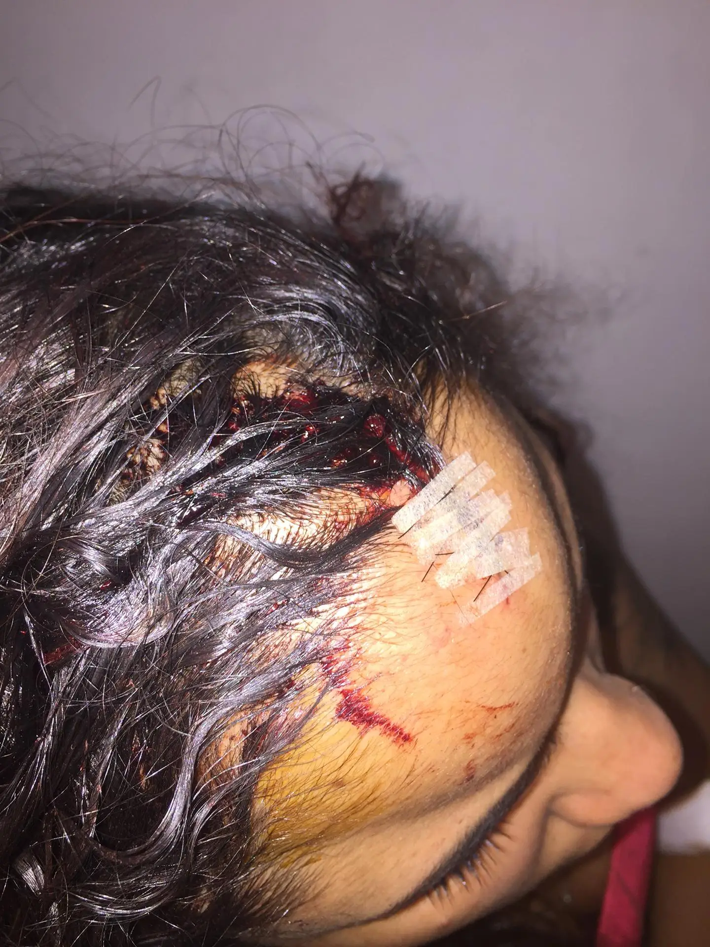 Foi assim que ficou a cabeça de Carolina (nome fictício) após a intervenção de um agente da PSP com um cassetete na noite de domingo, no Cais do Sodré, em Lisboa