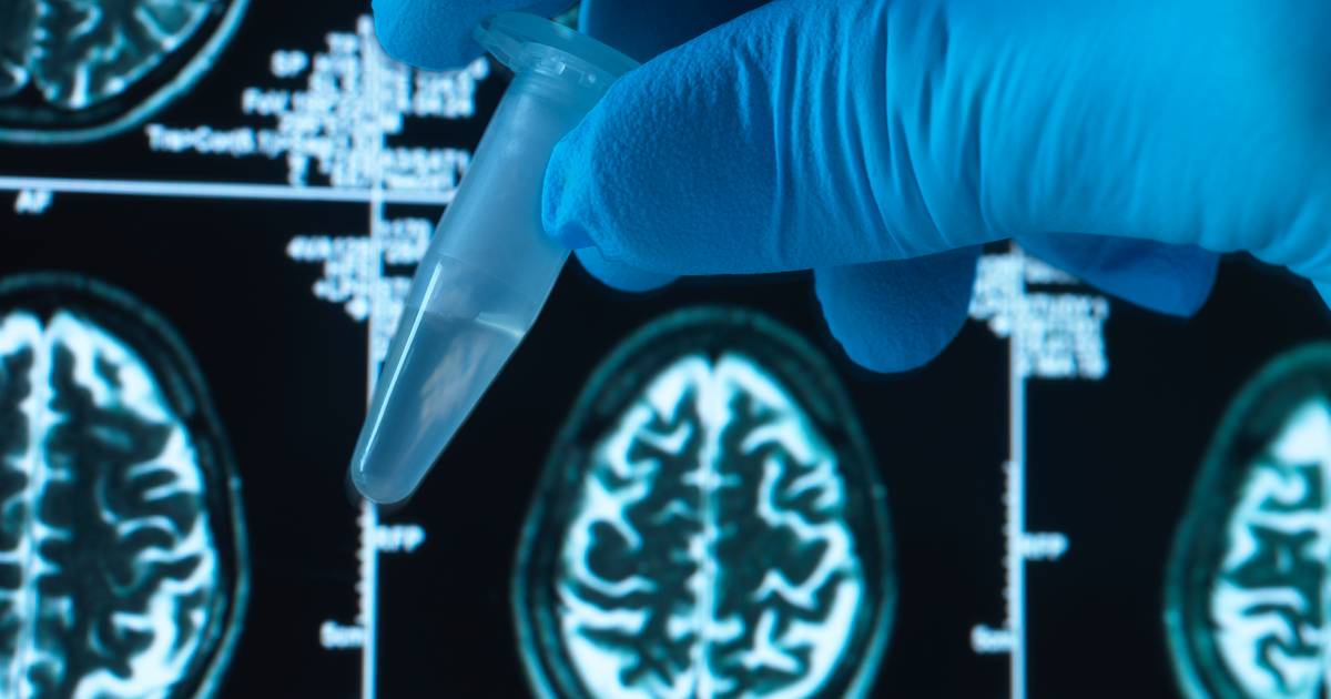 Novo medicamento é capaz de retardar a progressão da doença de Alzheimer em 35%