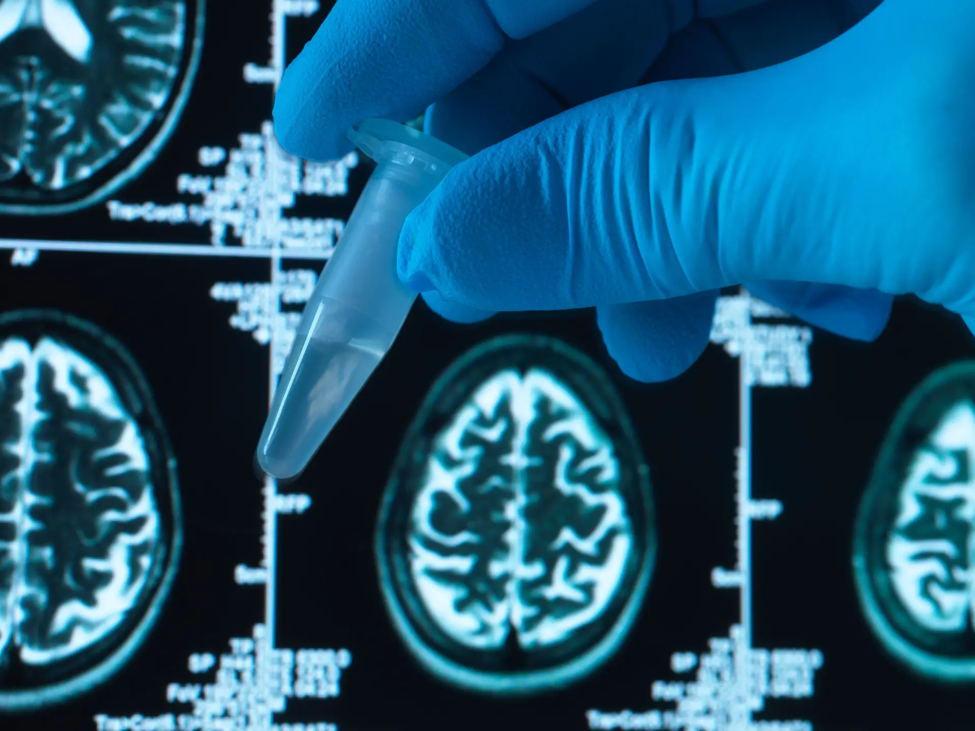 Risco de desenvolver Alzheimer “substancialmente maior” entre idosos que tiveram covid-19
