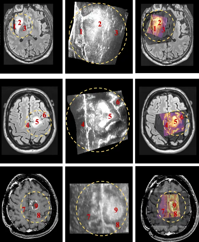 Antes e depois dos ultrassons: Na primeira coluna, encotram-se imagens de ressonância magnética de três pacientes com tumores cerebrais. Na segunda coluna figuram três imagens produzidas com ultrassons dos cérebros dos mesmos pacientes. E por fim, na terceira coluna encontram-se as imagens produzidas pelos algoritmos desenvolvidos por Inês Machado, que combinam ultrassons e ressonância magnética
