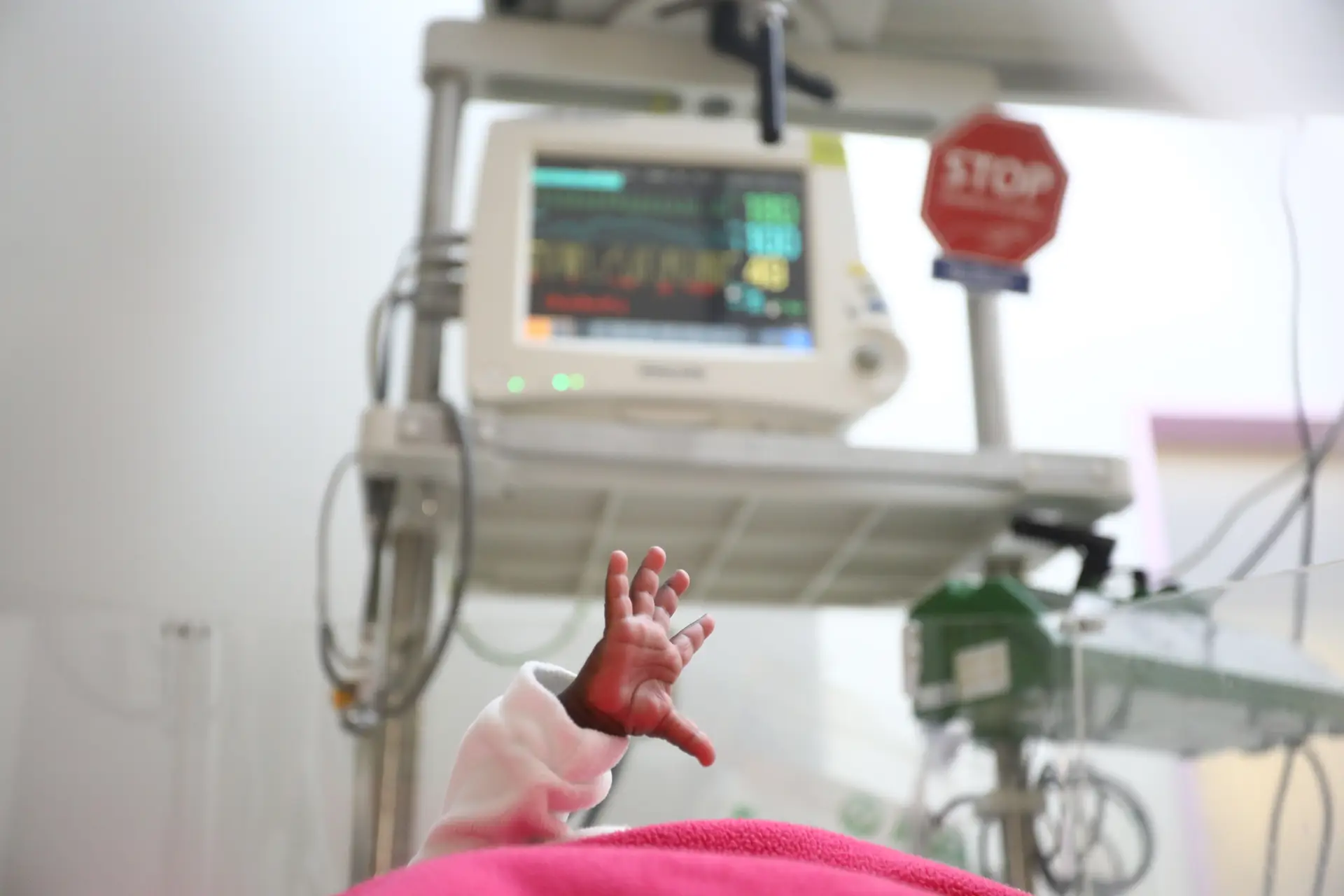 Bactéria isola neonatologia no Hospital de Santa Maria, prematuros e grávidas de risco transferidos para outros hospitais