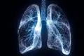 Pneumonia rara surge em doentes de covid curados