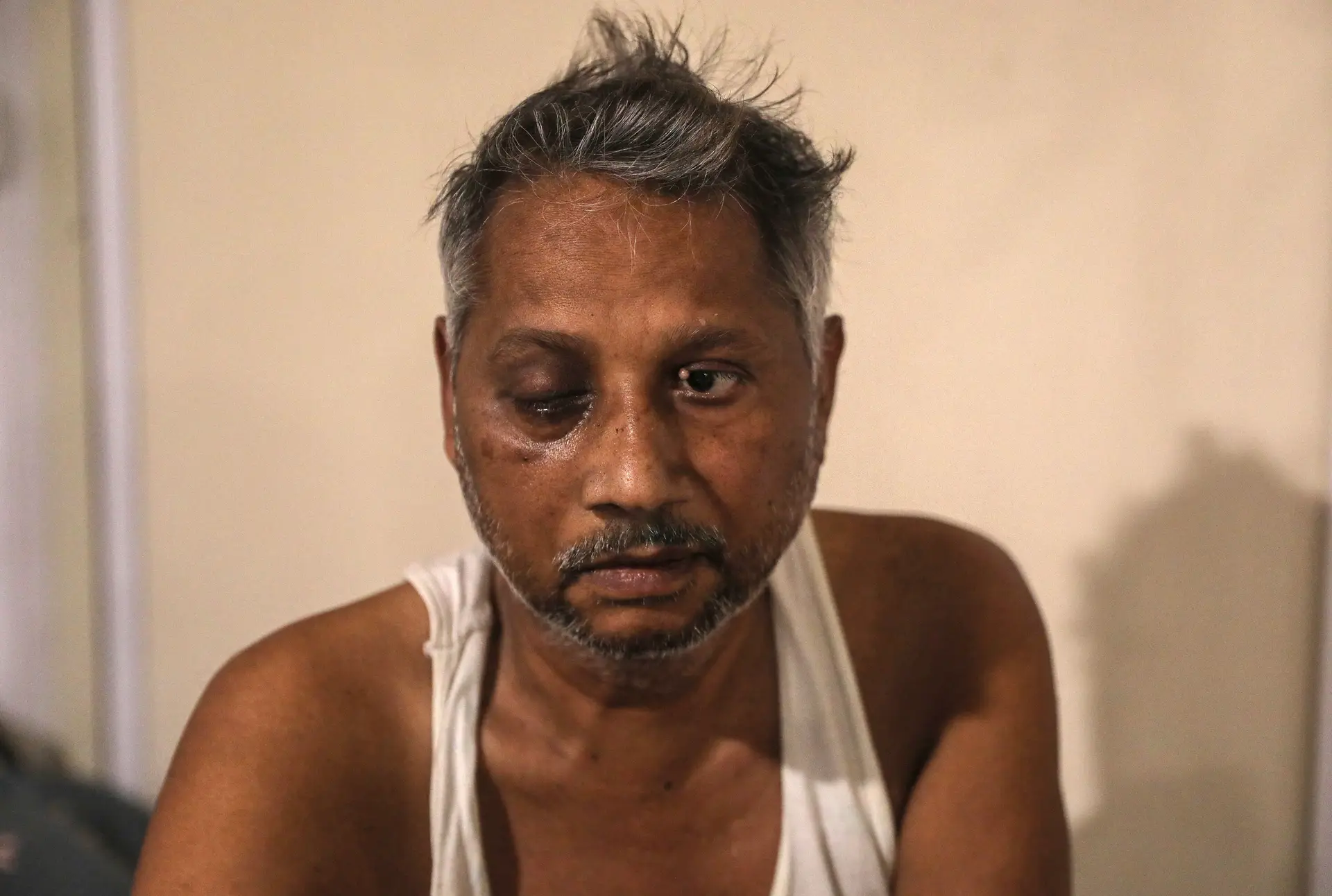 Um doente suspeito de ter mucormicose recebe tratamento em Ghaziabad, na Índia