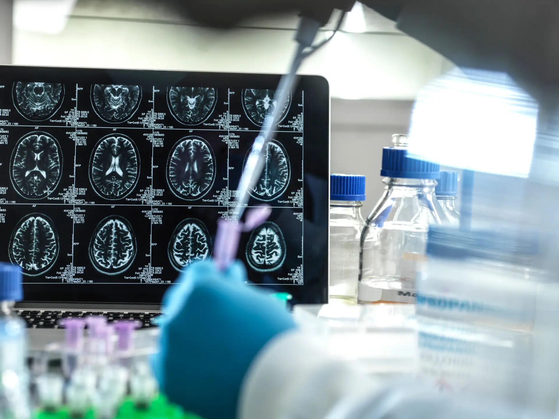 Ensaios mostram que novo tratamento para Alzheimer reduz declínio cognitivo em 27%