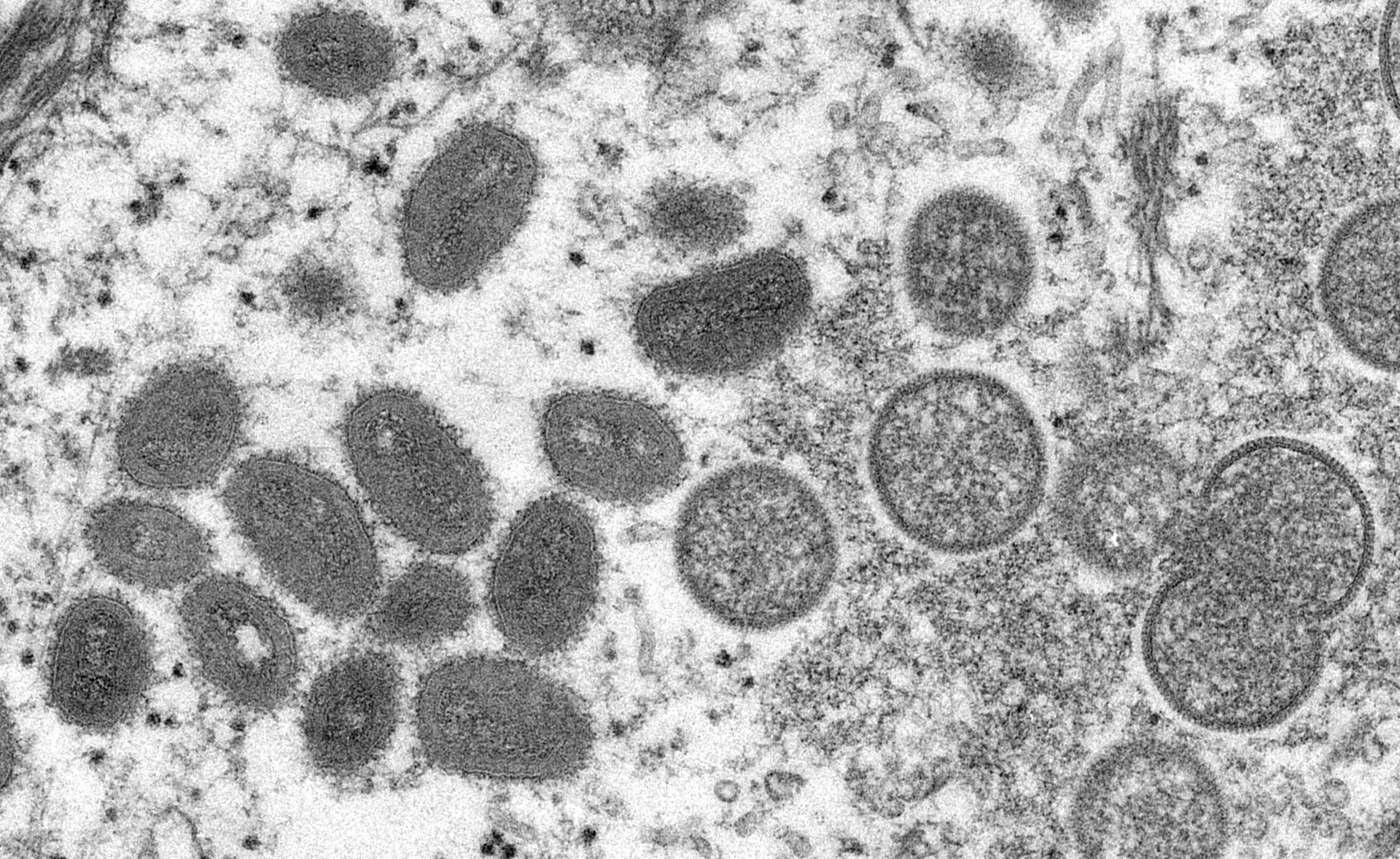 Monkeypox: Número de infeções em Portugal sobe para 810