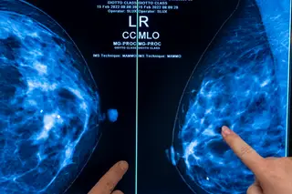 Teste de sangue deteta cancro de mama mais cedo do que a mamografia e pode aumentar a sobrevida