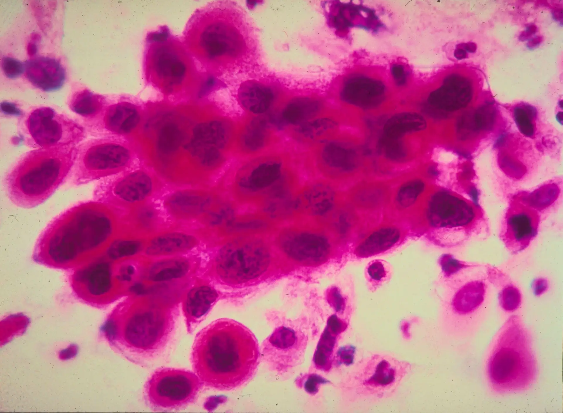 Investigadores italianos descobrem uma vacina contra o cancro