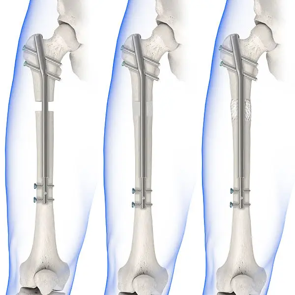 Cirurgia de alongamento ósseo