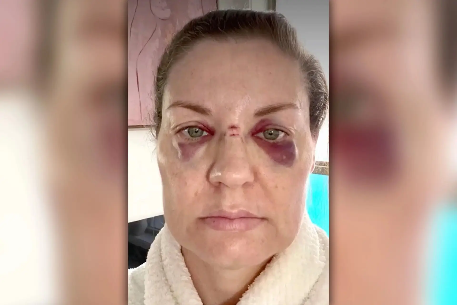 Axl Rose atira microfone e acerta em cheio no nariz de uma fã