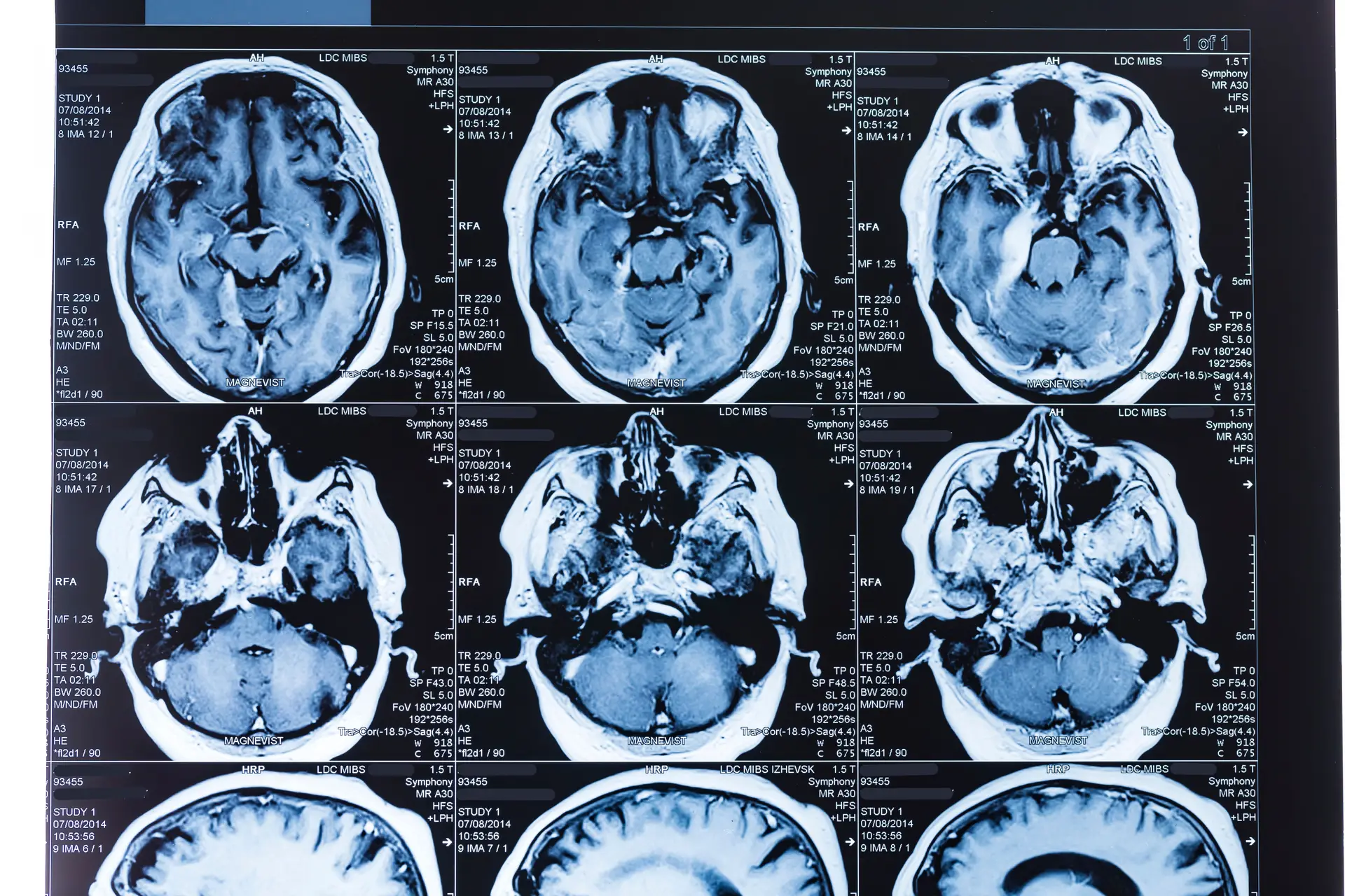 Estudo: a desigualdade de género provoca lesões no cérebro das mulheres e acarreta um maior risco de doença mental ou de declínio cognitivo