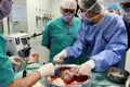 Saúde. Hospital Curry Cabral fez segundo transplante de fígado do mundo com robôs