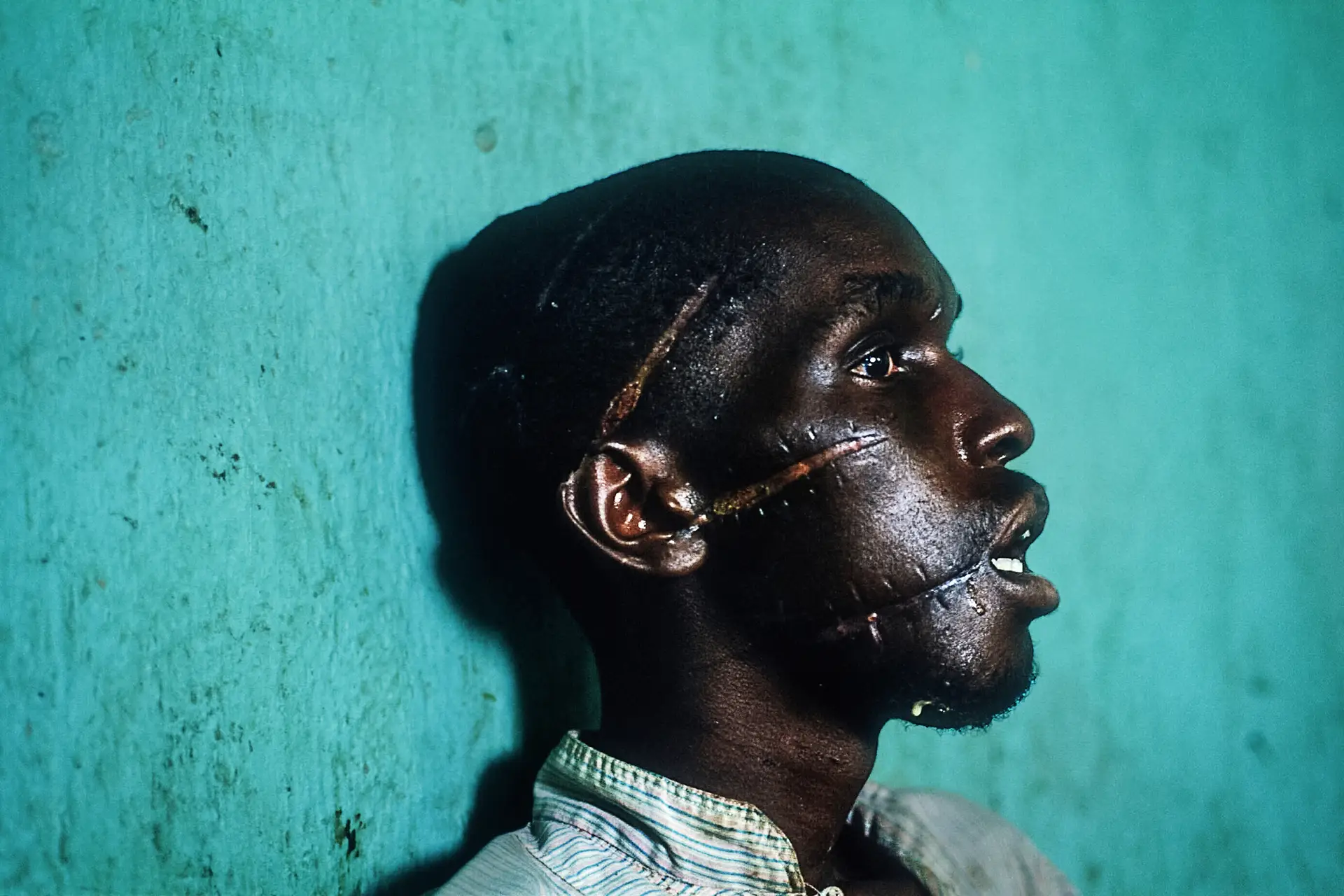 Homem tutsi com golpes na cara e na cabeça, sobrevivente do genocídio de 1994