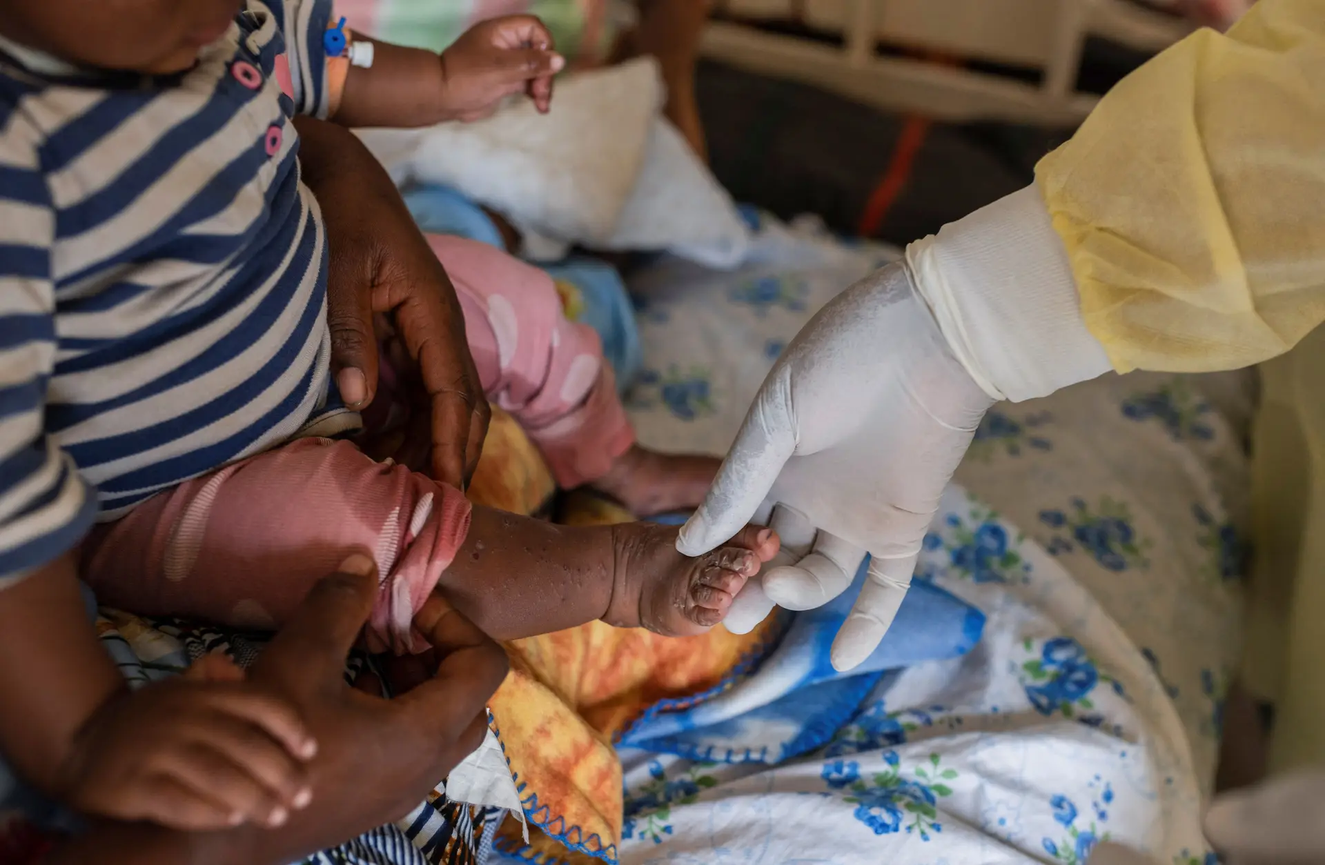 Surto de mpox em África: Organização Mundial de Saúde declara emergência global