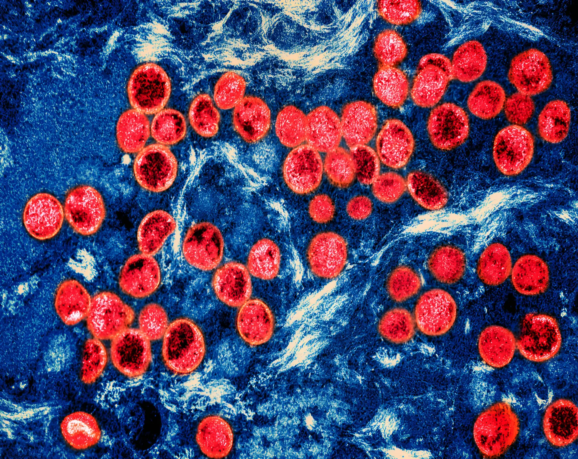 Suécia anuncia deteção do primeiro caso de mpox fora de África