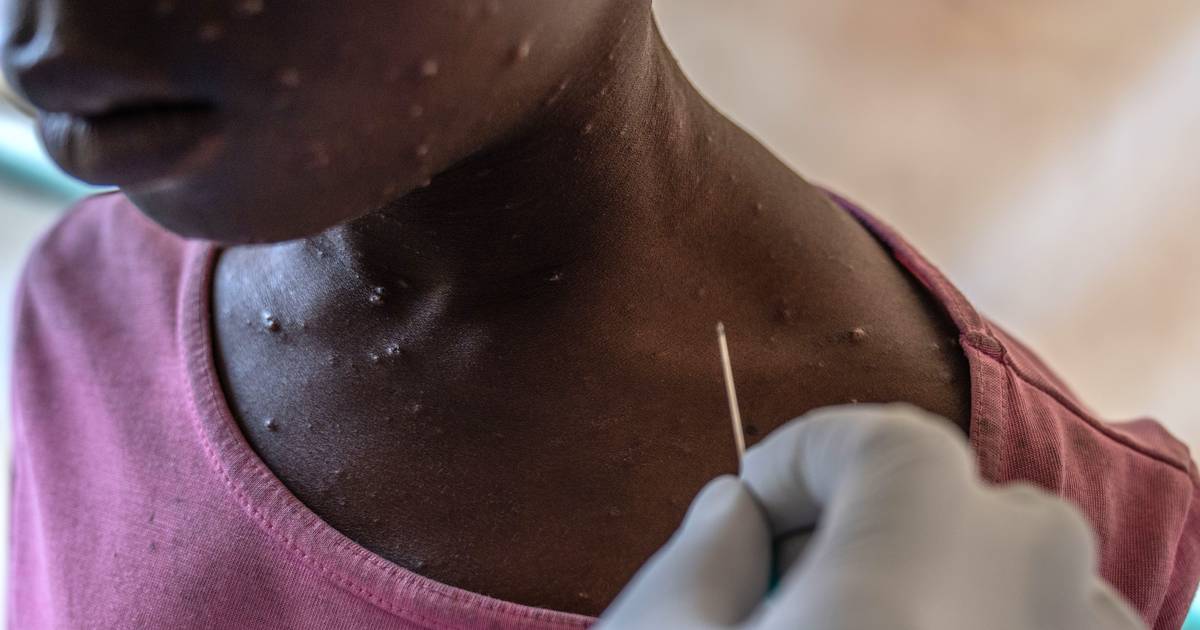 Le Portugal enregistre une transmission communautaire du nouveau sous-variant du mpox et de nouveaux cas en Europe