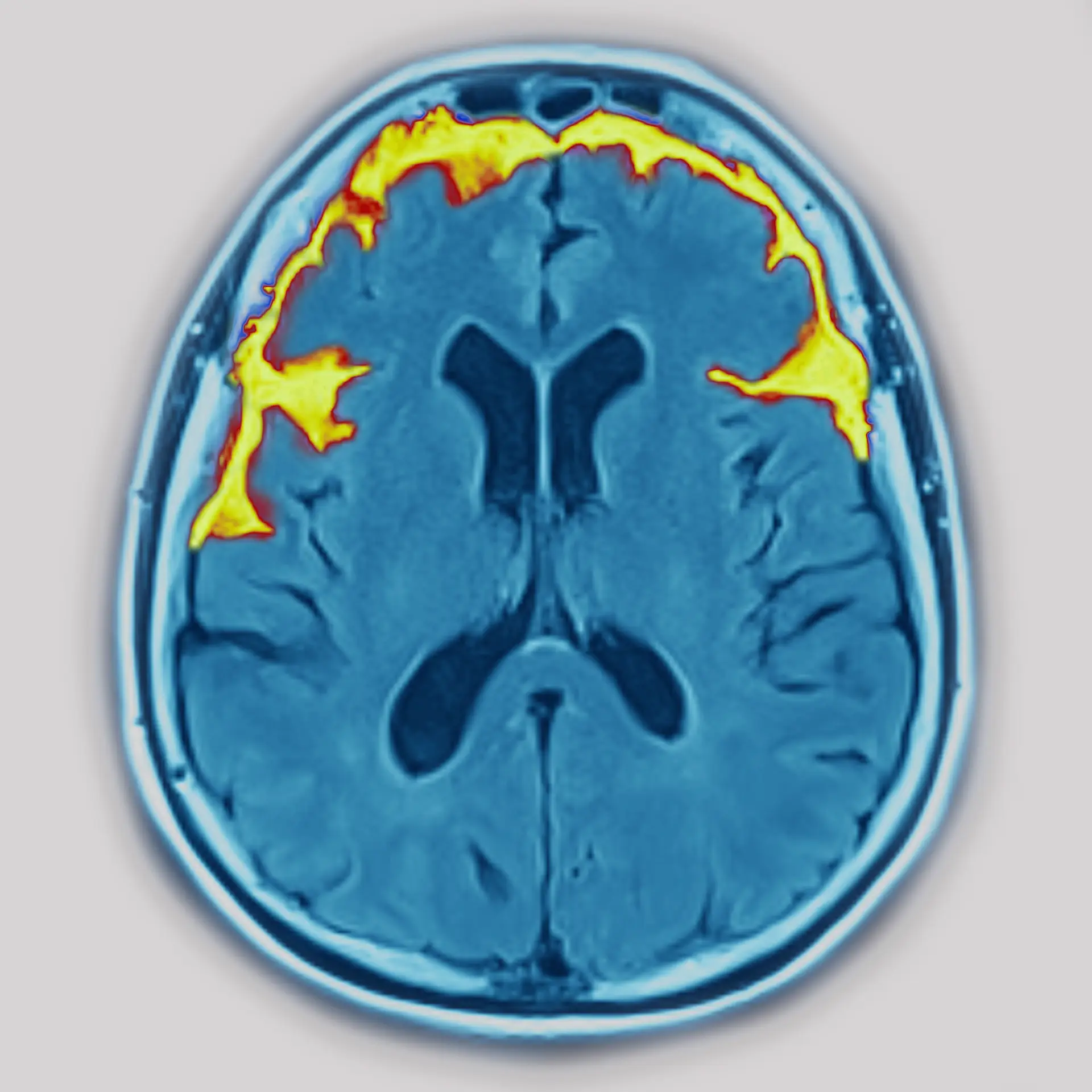 Atrofia cerebral causada pela doença de Alzheimer