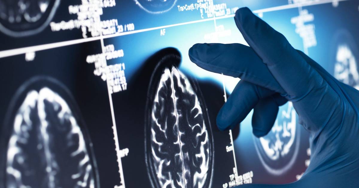 Cientistas identificam mecanismo que pode estar na origem do Alzheimer e da ELA