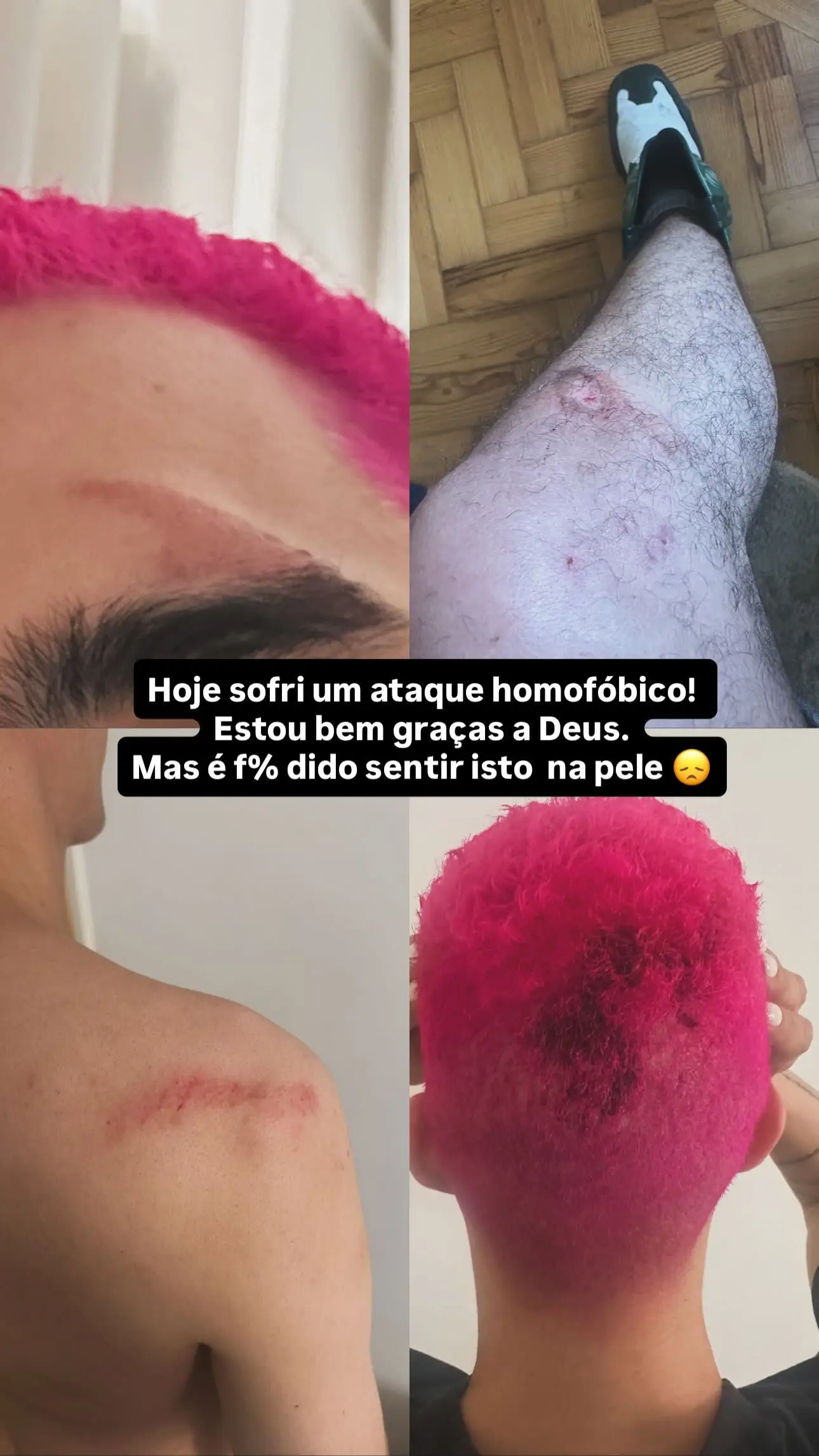 Luís Borges revela imagens chocantes de ferimentos no rosto e no corpo