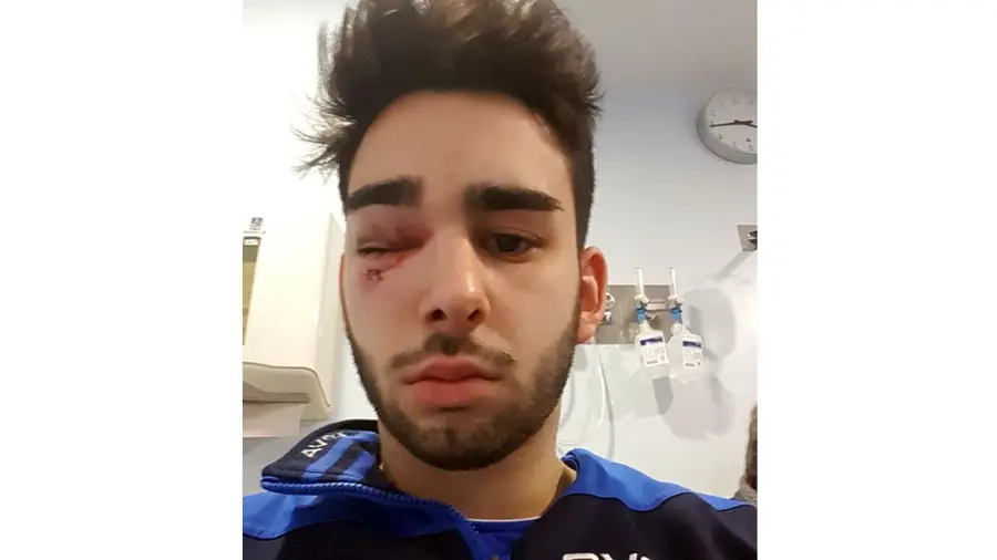 Jogador dos Tigres de Almeirim sofre lesão grave num olho Jogador dos Tigres de Almeirim sofre lesão grave num olho