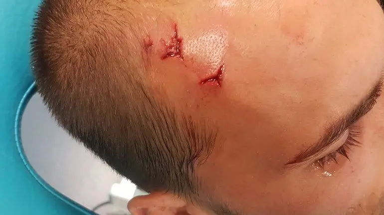 Bas Dost ficou neste estado após ter sido agredido na Academia de Alcochete