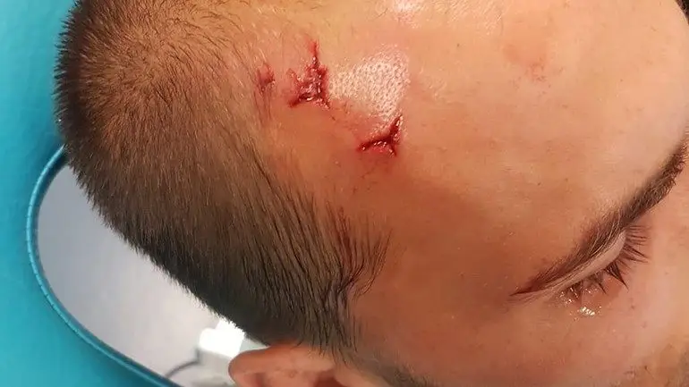 Bas Dost ficou neste estado após ter sido agredido na Academia de Alcochete