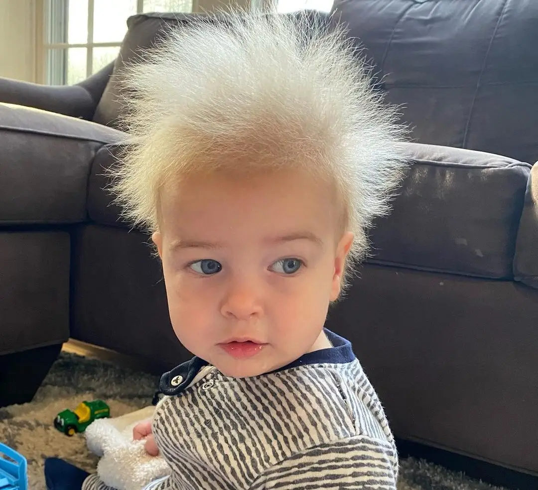 Criança diagnosticada com síndrome do cabelo que não se penteia vira sucesso nas redes sociais