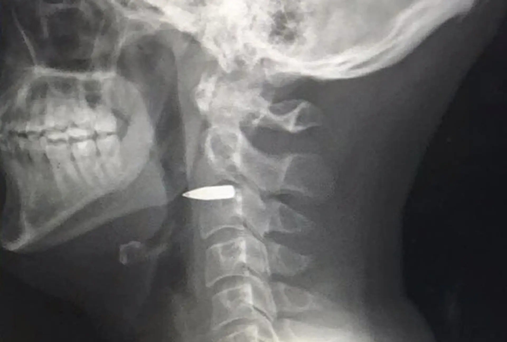 Jornalista sobrevive após ser baleado no pescoço nas Filipinas