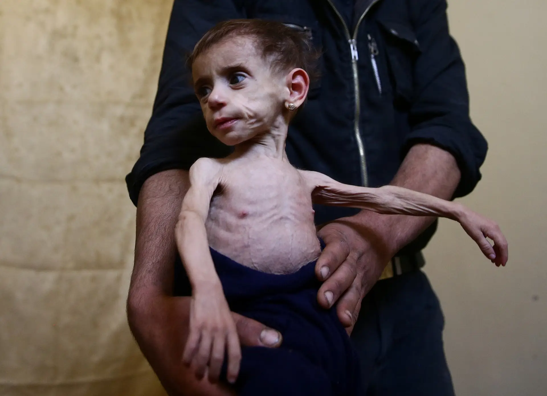 Hala al-Nufi tem 2 anos e meio e pesa menos de 5 quilos. Sofre de um distúrbio metabólico, mas a falta de comida tornou a sua situação ainda mais grave. Os pais de Hala receiam que a filha não sobreviva ao cerco. 