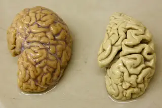 Cientistas anunciam nova estratégia de combate à doença de Alzheimer