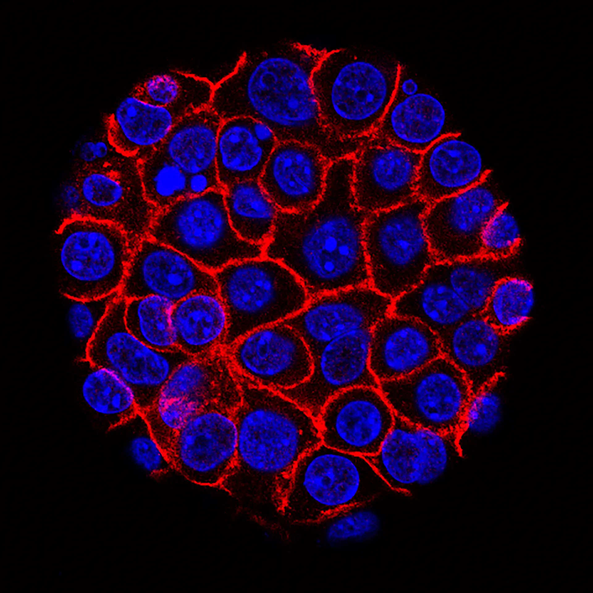 Células cancro do pâncreas, com núcleo a azul a crescer como uma esfera envolvida em mebranas, a vermelho.