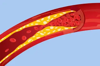 Dislipidemia: sabe que doença é esta?
