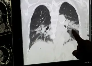 Um médico analisa os pulmões de um doente infetado pelo coronavírus em Liège, Bélgica