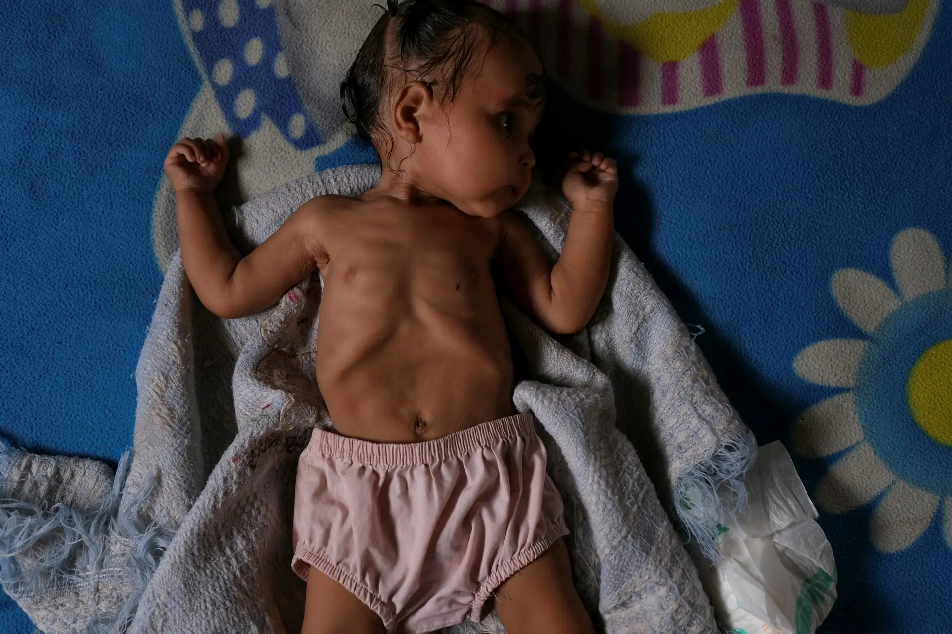 Sonia tem sete meses. É venezuelana, está malnutrida e continuamente a perder peso.