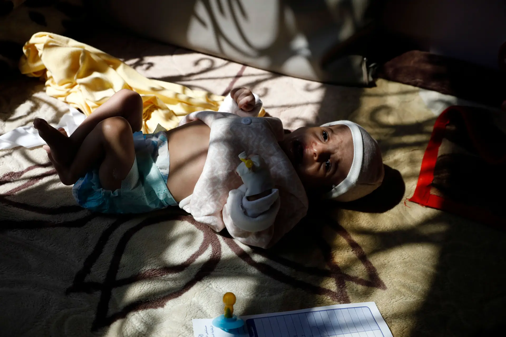 Uma criança desnutrida deitada numa cama enquanto recebe cuidados médicos num hospital em Saná, no Iémen. A ONU e grupos de ajuda humanitária alertaram que a designação dos Houthis pelos EUA como organização terrorista estrangeira pode ter sérios impactos sobre a já terrível situação humanitária no Iémen, particularmente sobre o risco de fome.
