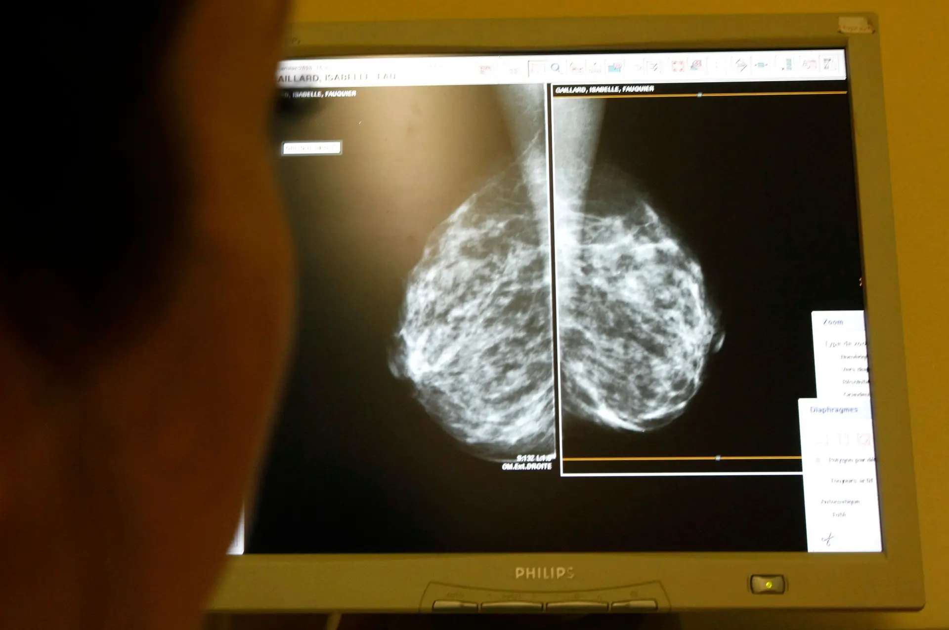 O avançar da idade faz aumentar o risco de cancro da mama. Uma mulher de 60 anos, por exemplo, tem oito vezes mais hipóteses de desenvolver a doença em 5 anos, do que uma mulher de 30